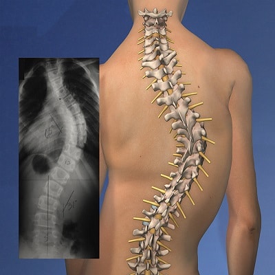 scoliosis servises Lahore doctor